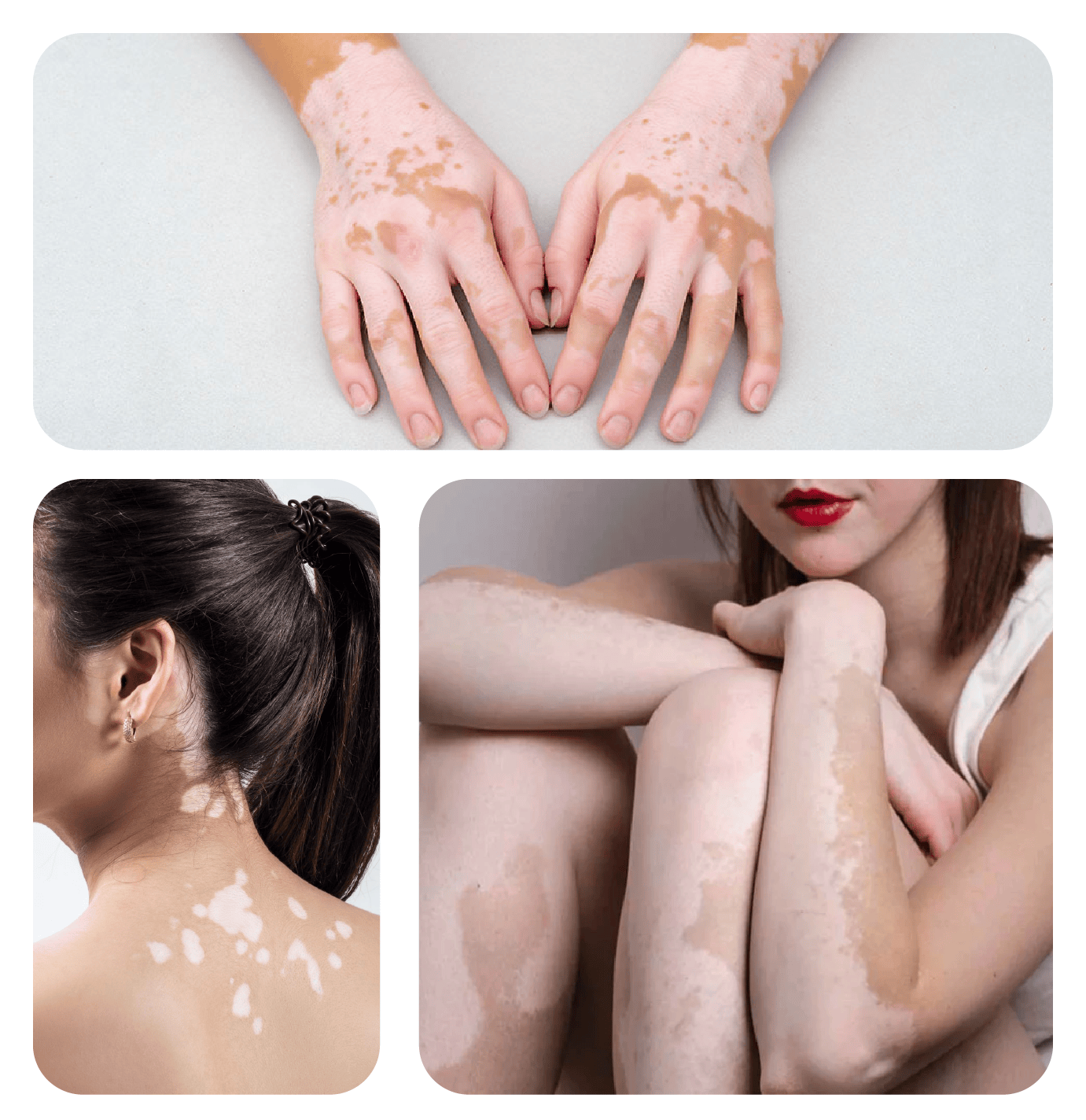 vitiligo causes