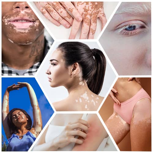 vitiligo symptoms