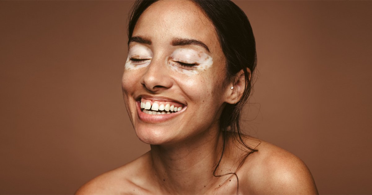 Ayurveda Vitiligo Treatment