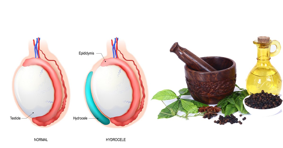 Ayurvedic Varicocele Treatment