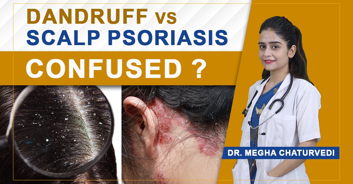 Dandruff vs. Scalp Psoriasis
